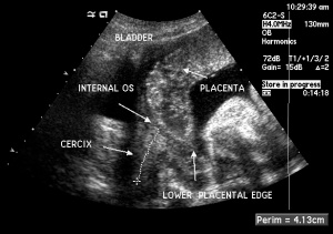 Placenta-Previa-Ultrasound